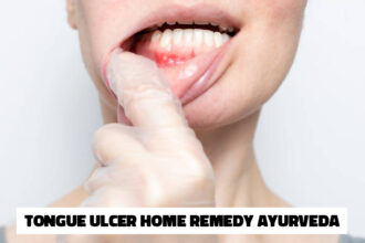 Tongue Ulcer Home Remedy Ayurveda