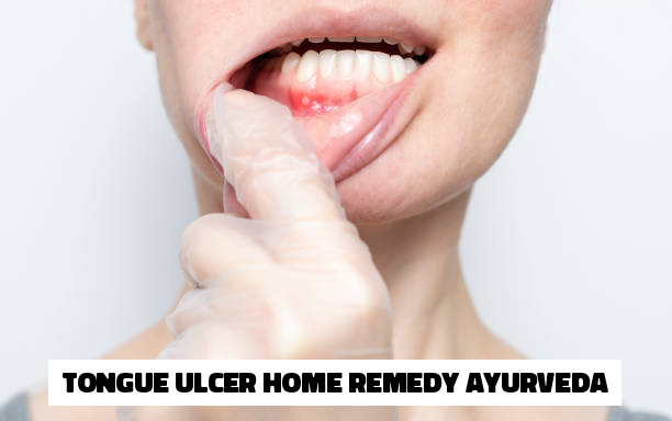 Tongue Ulcer Home Remedy Ayurveda